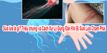 Sứa lửa là gì? Triệu chứng và Cách Xử Lý Đúng Đắn Khi Bị Sứa Lửa Chạm Phải