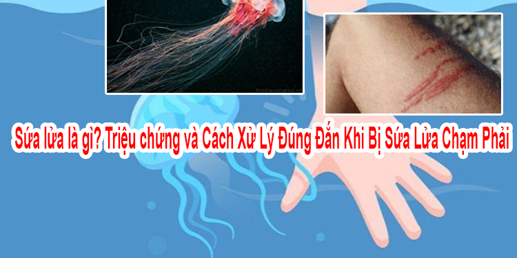 Sứa lửa là gì? Triệu chứng và Cách Xử Lý Đúng Đắn Khi Bị Sứa Lửa Chạm Phải